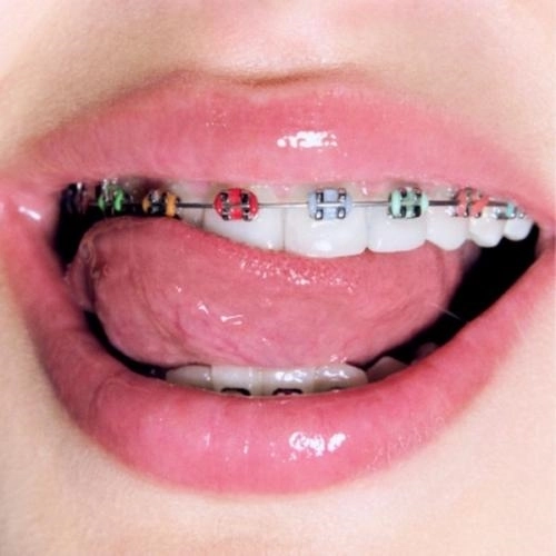 Брекеты (Speed Up)